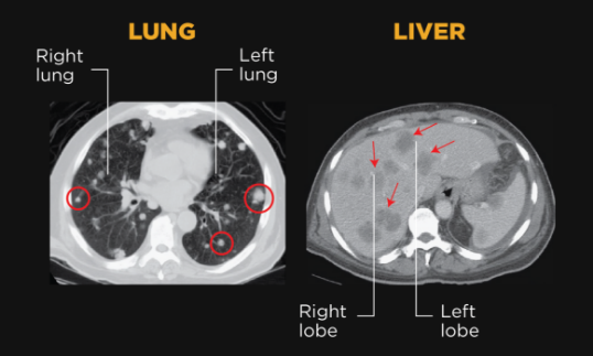 Lung and liver