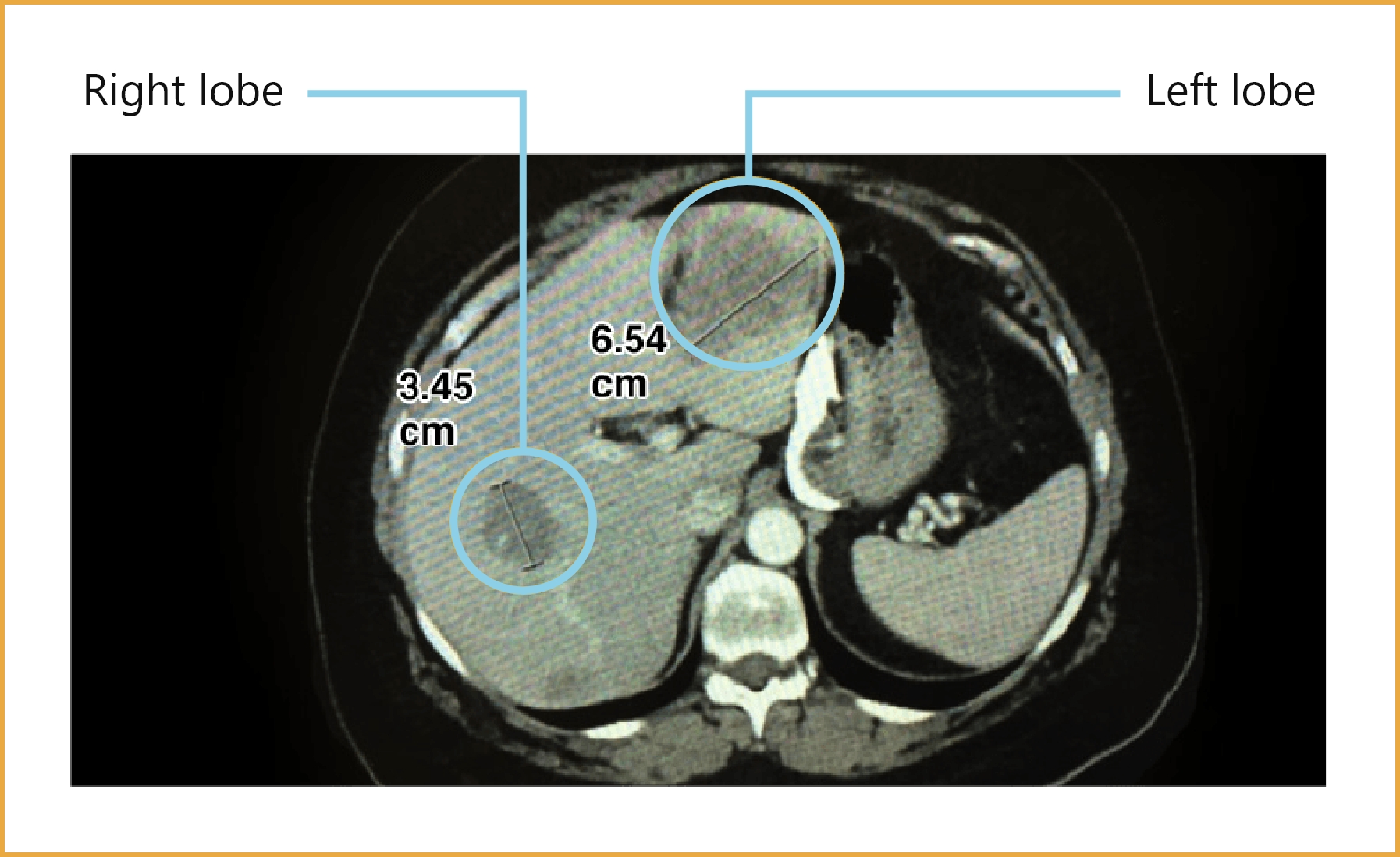 Right lobe and left lobe of liver